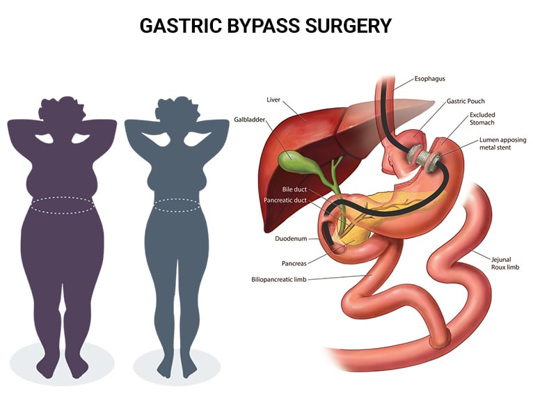 Gastric Bypass Surgery New Jersey